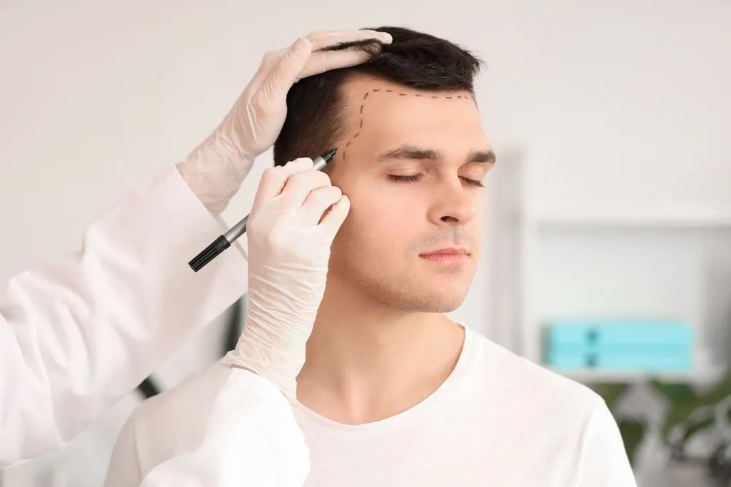 The Hair Transplant Journey: A Step-By-Step Guide
